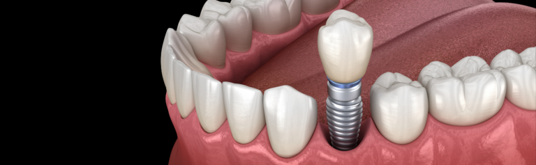 Having a Dental Implant: What You Need to Know