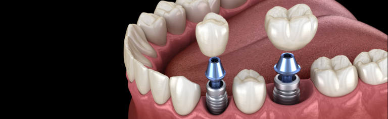 The Cost of Dental Implants