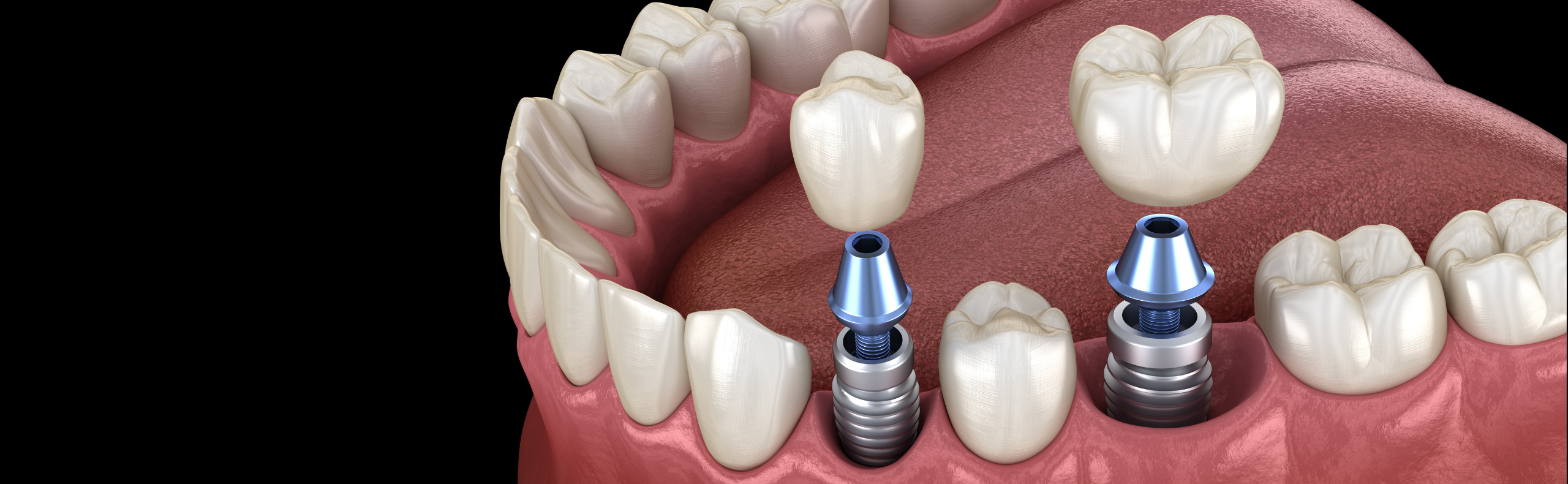 The cost of dental implants