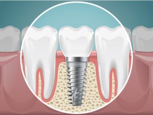 Artist’s impression of a dental implant and adjacent molar tooth in cross-section
