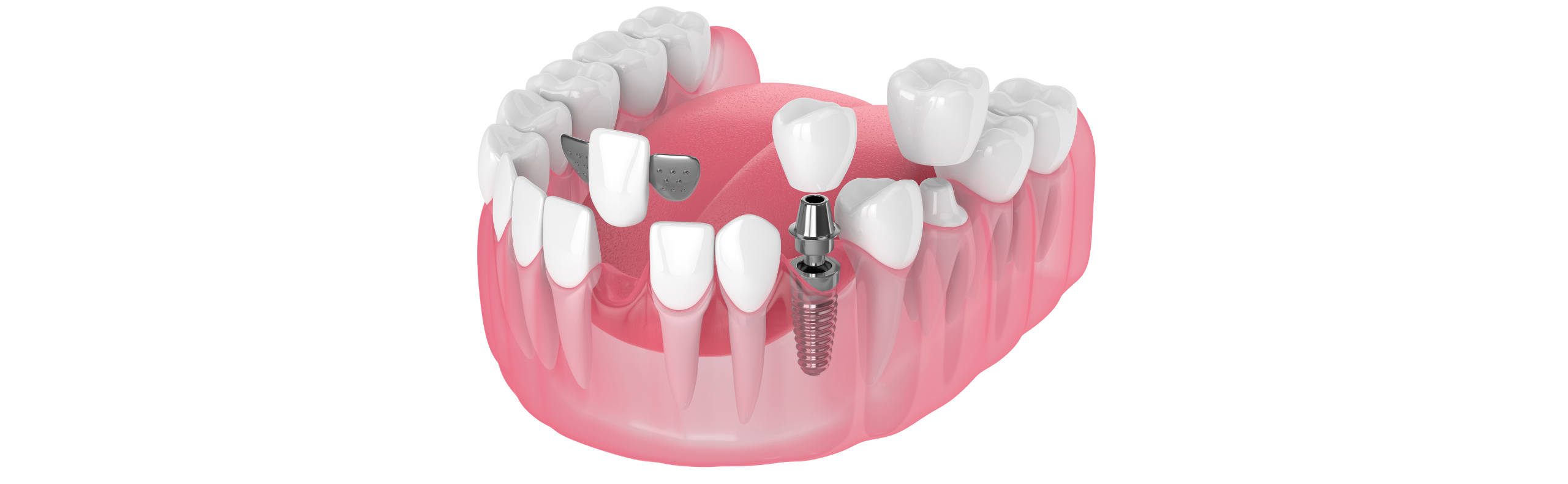 Management Of Missing Teeth Options For Tooth Replacement